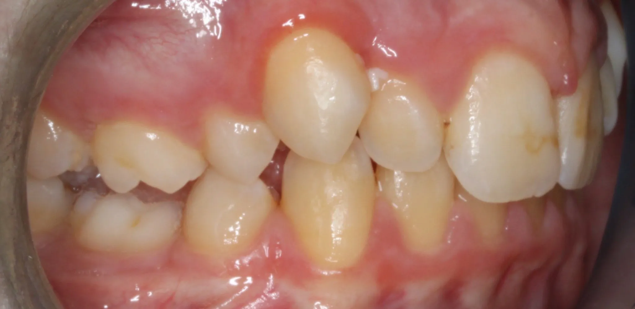 Before photo (left side view of teeth): Dental Expanders & Braces for Severe Crowding, Case Study #1