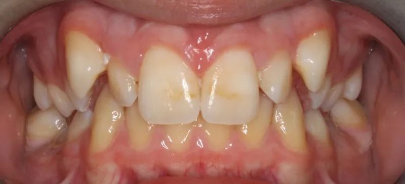 Before photo (front view of teeth): Dental Expanders & Braces for Severe Crowding, Case Study #1