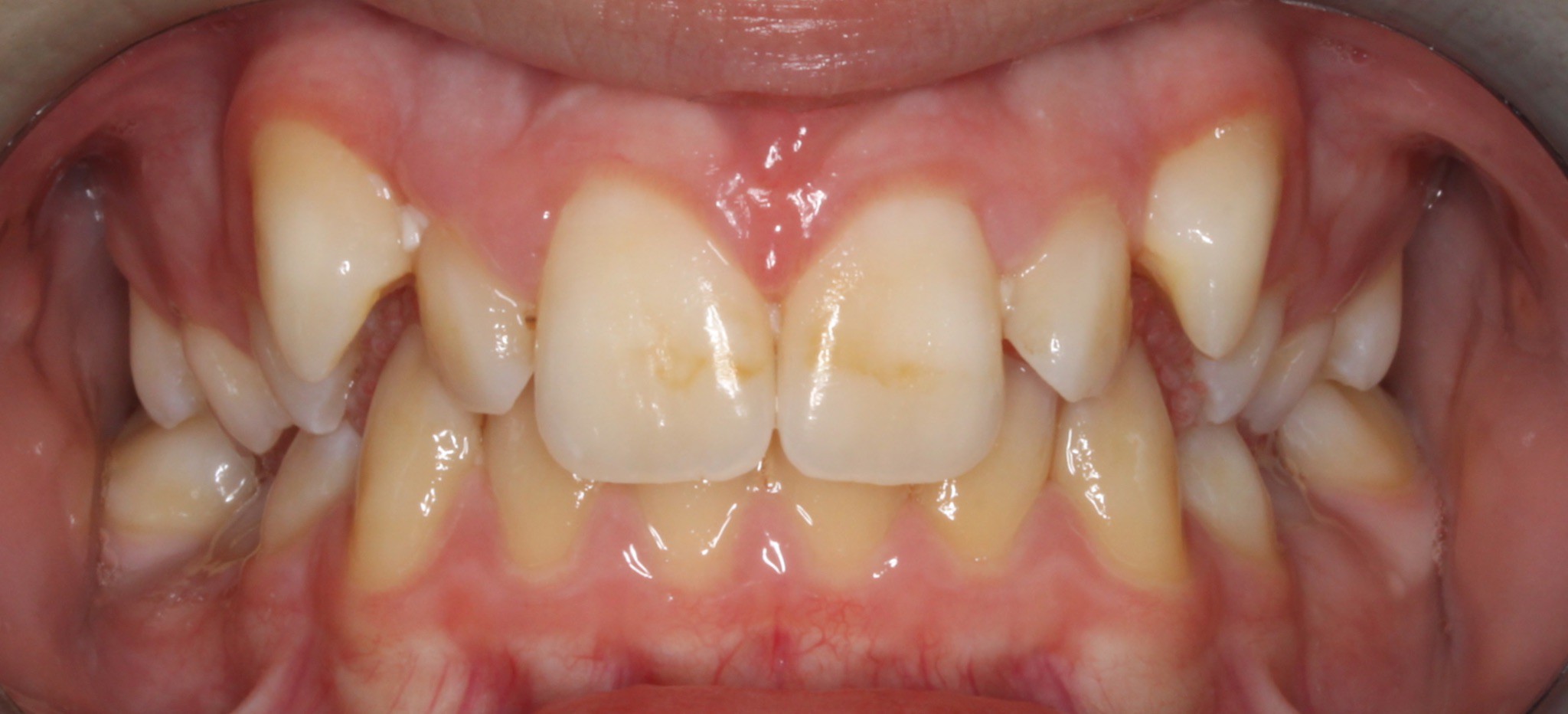 Before photo (front view of teeth): Dental Expanders & Braces for Severe Crowding, Case Study #1