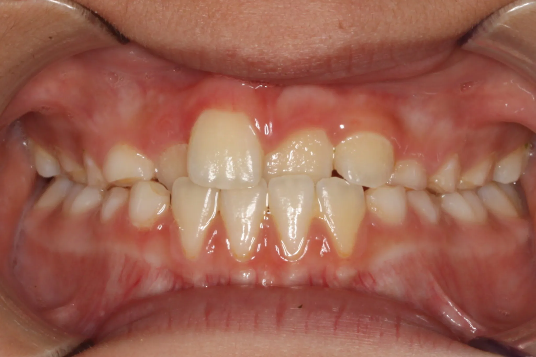 Before photo: Partially erupted and crooked teeth