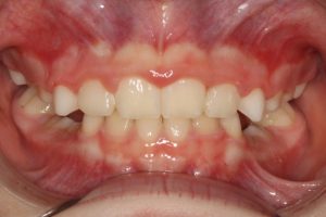 After photo (front view of teeth): Palate Expander and Top Braces, Case Study #2
