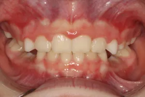 After photo (front view of teeth): Palate Expander and Top Braces, Case Study #2