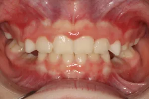 After photo (front view of teeth): Palate Expander and Top Braces, Case Study #2