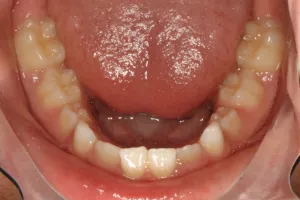 Before photo (inside view of teeth): Palate Expander and Top Braces, Case Study #2