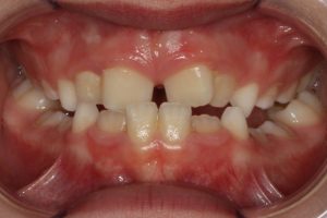 Before photo (front view of teeth): Palate Expander and Top Braces, Case Study #2
