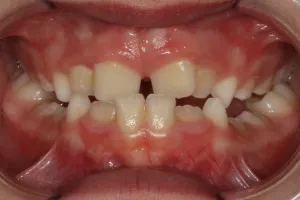 Before photo (front view of teeth): Palate Expander and Top Braces, Case Study #2