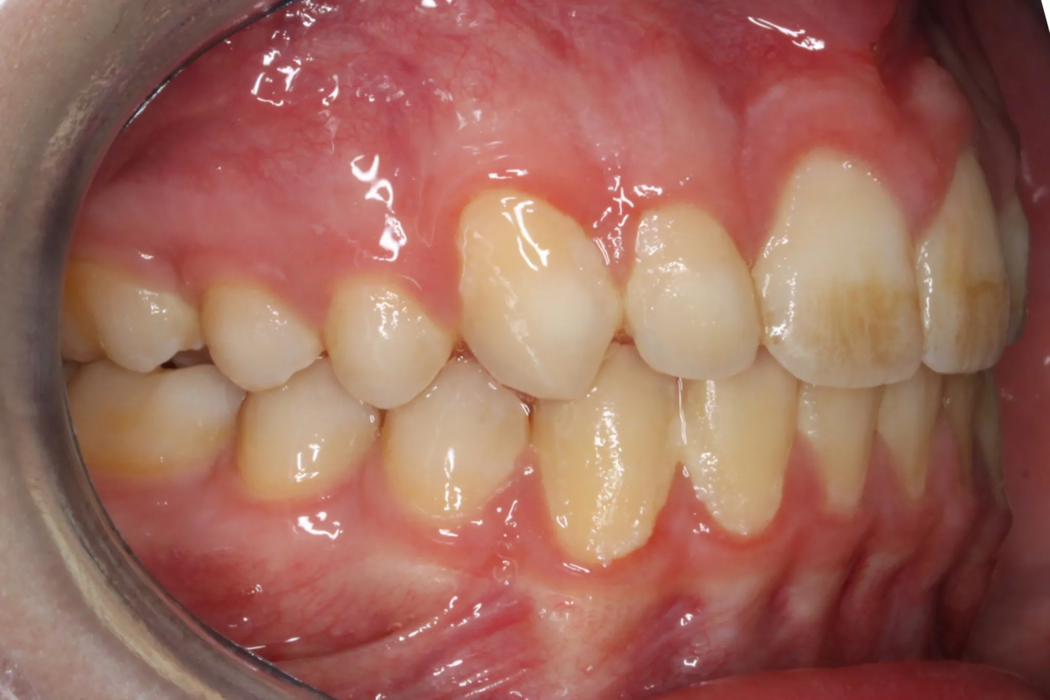 After photo (left side view of teeth): Dental Expanders & Braces for Severe Crowding, Case Study #1