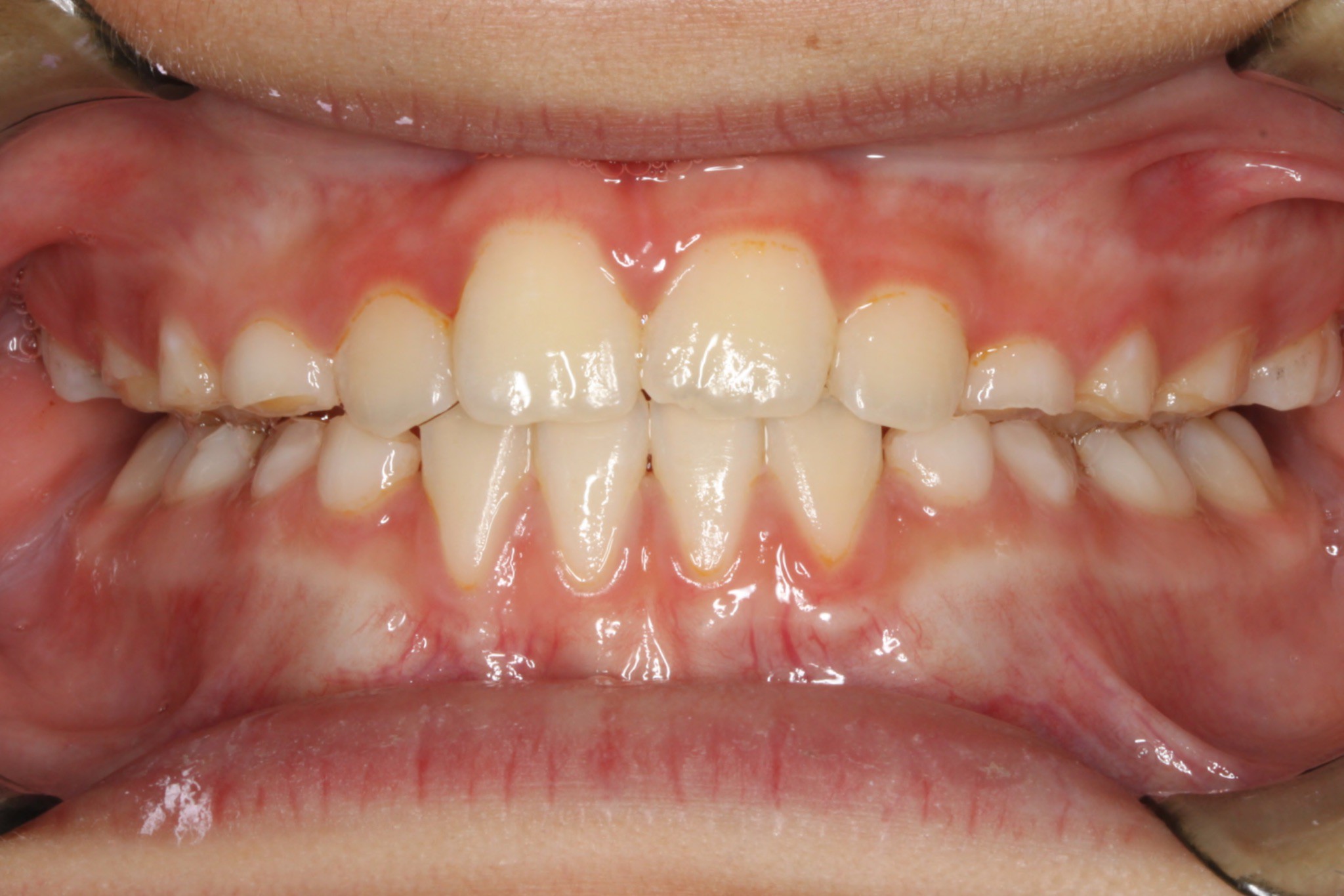 After photo: Fully erupted, straightened teeth