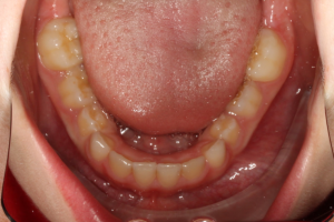 After photo (inside view of teeth): Palate Expander and Top Braces, Case Study #2