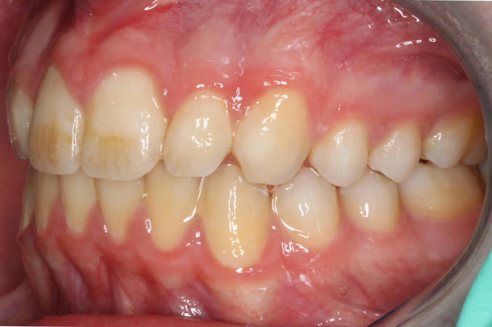 After photo (right side view of teeth): Dental Expanders & Braces for Severe Crowding, Case Study #1
