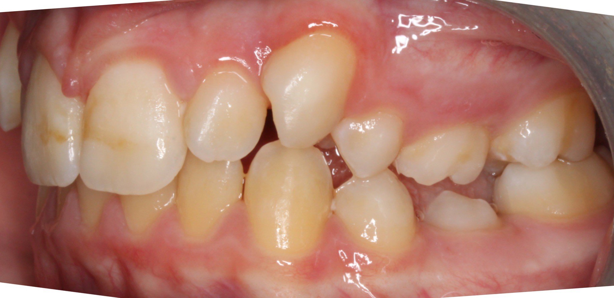 Before photo (right side view of teeth): Dental Expanders & Braces for Severe Crowding, Case Study #1