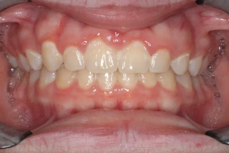 After Photo: Spacing issues with gaps in upper teeth