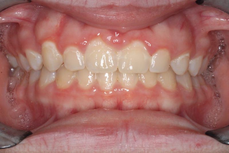 After Photo: Spacing issues with gaps in upper teeth