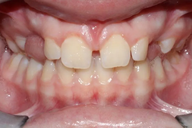 Before Photo: Spacing issues with gaps in upper teeth