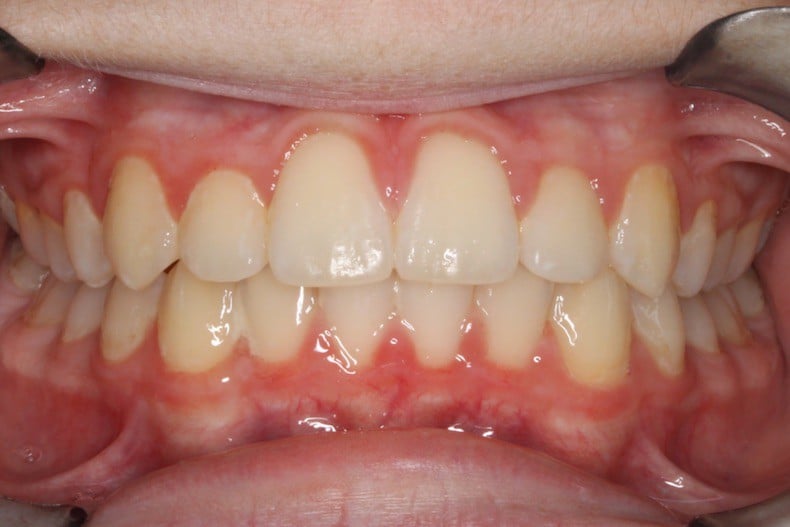 After photo (front view of teeth): Severe Dental Crowding - Palate Expander & Braces, Case Study #3