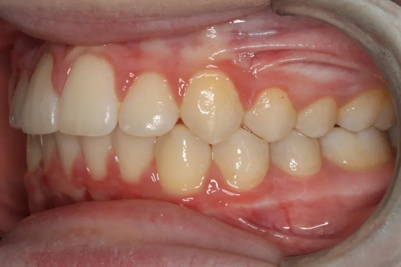 After photo (right side view of teeth): Severe Dental Crowding - Palate Expander & Braces, Case Study #3