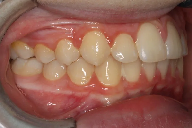 After photo (left side view of teeth): Severe Dental Crowding - Palate Expander & Braces, Case Study #3