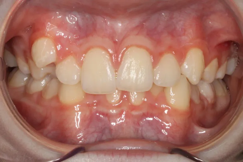 Before photo (front view of teeth): Severe Dental Crowding - Palate Expander & Braces, Case Study #3
