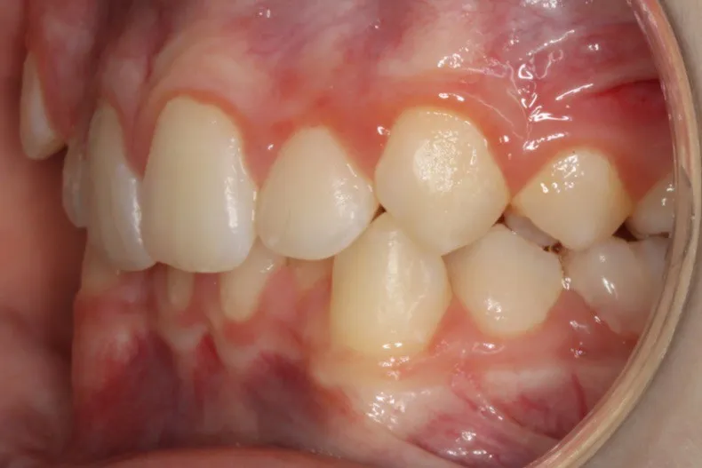 Before photo (right side view of teeth): Severe Dental Crowding - Palate Expander & Braces, Case Study #3