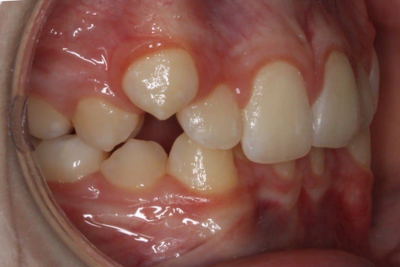 Before photo (left side view of teeth): Severe Dental Crowding - Palate Expander & Braces, Case Study #3