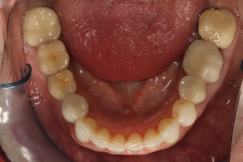 After photo (bottom teeth): Invisalign for Teeth Crowding, Case Study #2