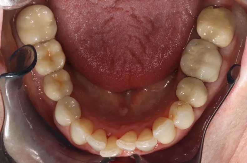 Before photo (bottom teeth): Invisalign for Teeth Crowding, Case Study #2