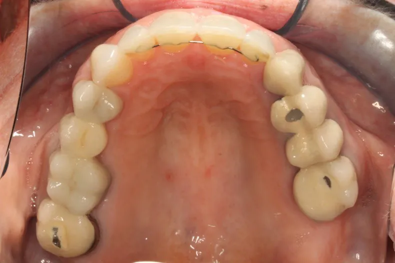 After photo (top teeth): Invisalign for Teeth Crowding, Case Study #2