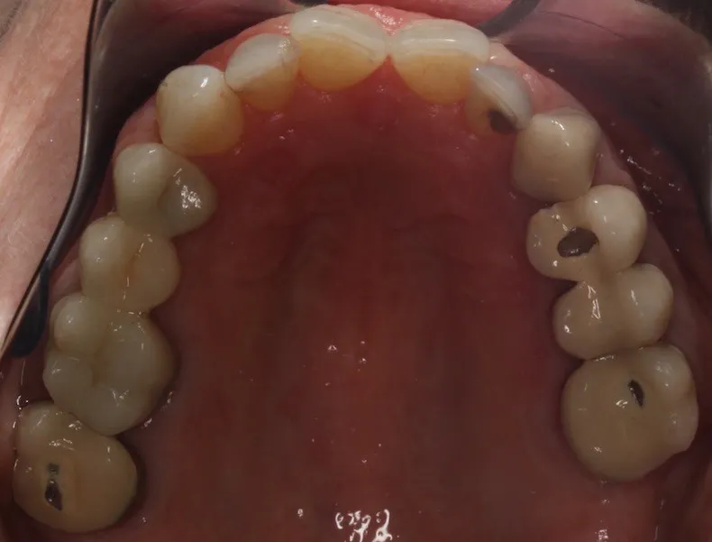 Before photo (top teeth): Invisalign for Teeth Crowding, Case Study #2