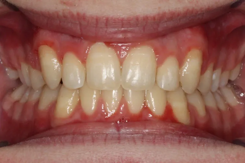 After photo (front view of teeth): Severe Dental Crowding - Palate Expander & Braces, Case Study #4
