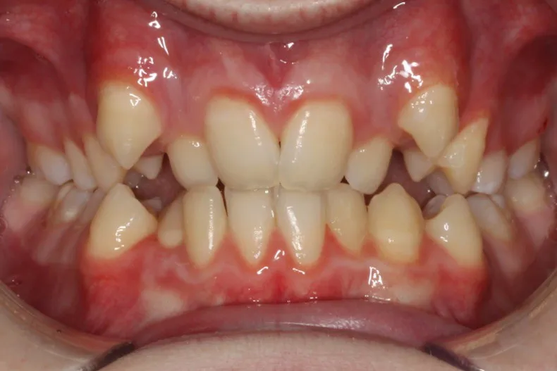 Before photo (front view of teeth): Severe Dental Crowding - Palate Expander & Braces, Case Study #4