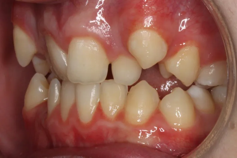 Before photo (right side view of teeth): Severe Dental Crowding - Palate Expander & Braces, Case Study #4