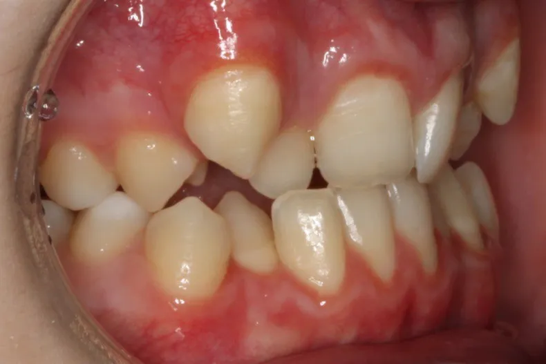Before photo (left side view of teeth): Severe Dental Crowding - Palate Expander & Braces, Case Study #4