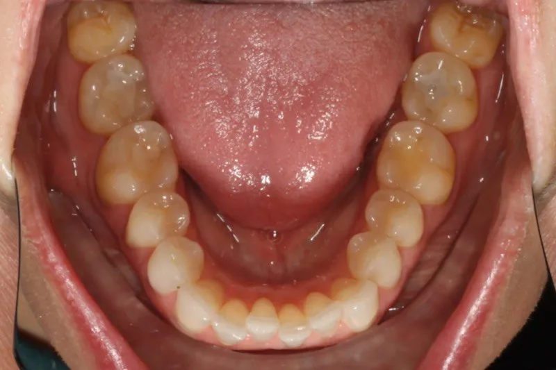 Invisalign Case Study 3: Before clear aligners with crooked front teeth, lower jaw