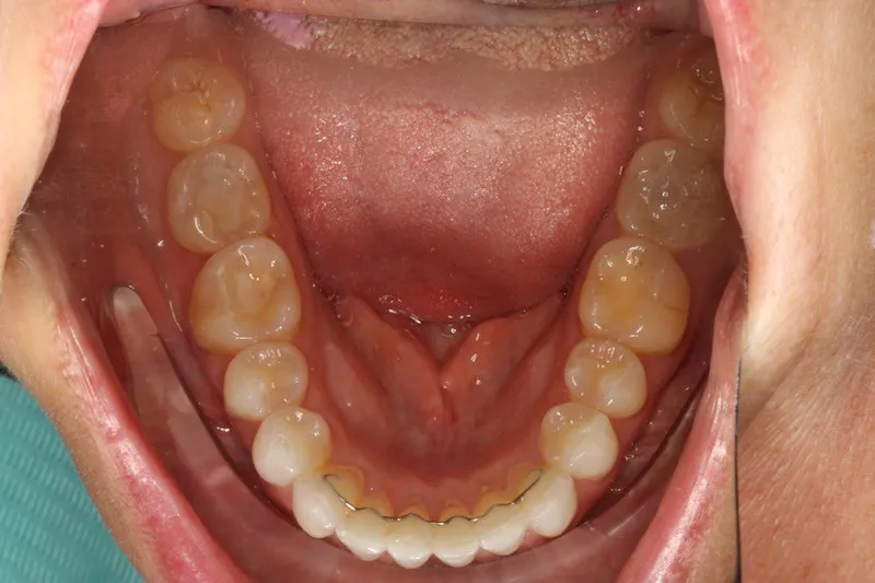 Invisalign Case Study 3: After clear aligner treatment with retainer, lower jaw