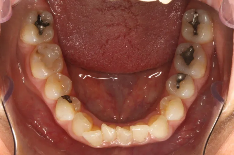 Invisalign Case Study 2: Before clear aligners with crooked, crowded teeth, lower jaw