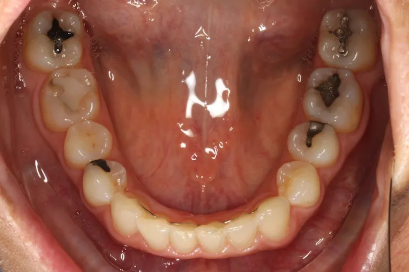 After photo (bottom teeth): Invisalign for Rotations/Crowding, Case Study #3