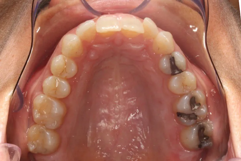 Invisalign Case Study 2: Before clear aligners with misaligned front teeth, upper jaw