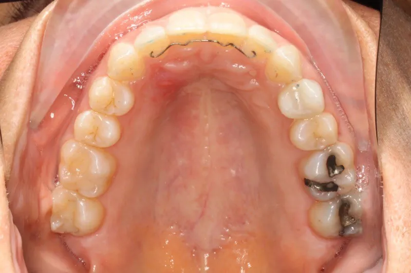 After photo (top teeth): Invisalign for Rotations/Crowding, Case Study #3