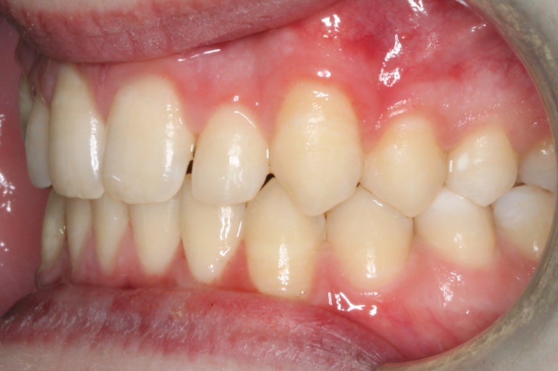 After photo (right side view of teeth): Severe Dental Crowding - Palate Expander & Braces, Case Study #4