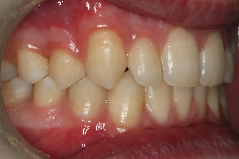 After photo (left side view of teeth): Severe Dental Crowding - Palate Expander & Braces, Case Study #4