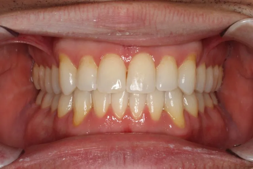 After photo (front view of teeth): Invisalign for Crowding & to Widen Arches, Case Study #1