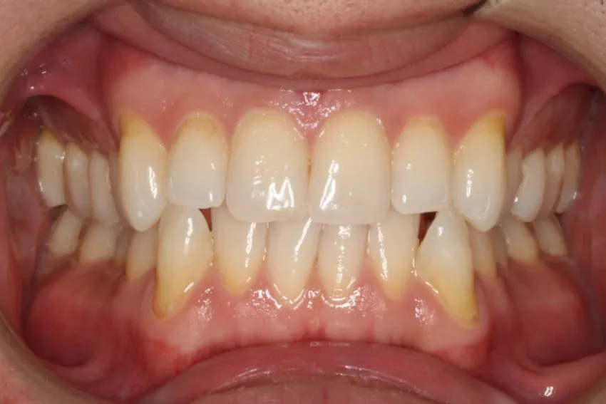 Before photo (front view of teeth): Invisalign for Crowding & to Widen Arches, Case Study #1