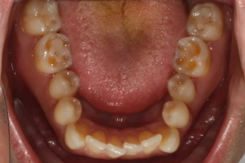 Before photo (inside view of teeth): Invisalign for Crowding & to Widen Arches, Case Study #1