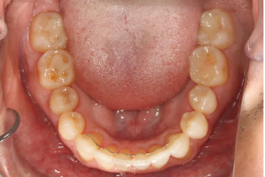 After photo (inside view of teeth): Invisalign for Crowding & to Widen Arches, Case Study #1