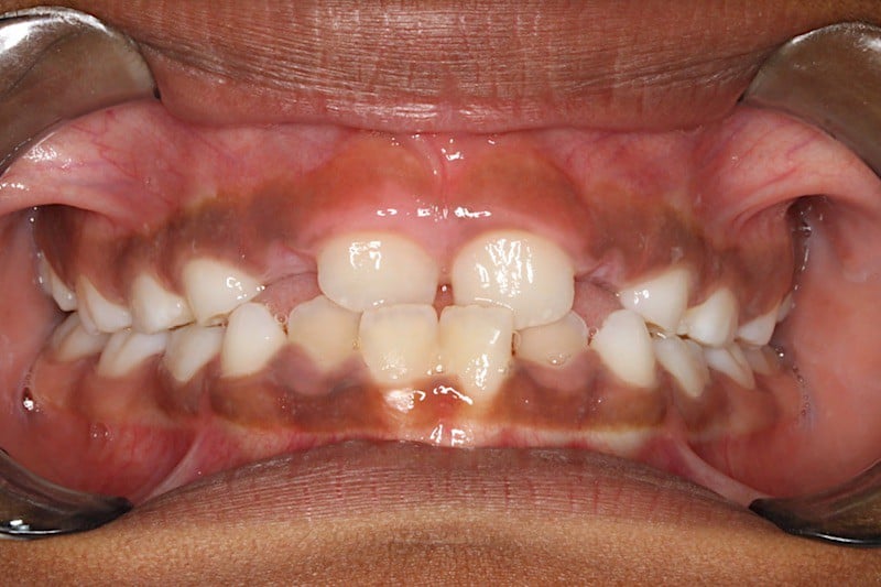 Before photo: Expander Case Study #3 in Somerville NJ