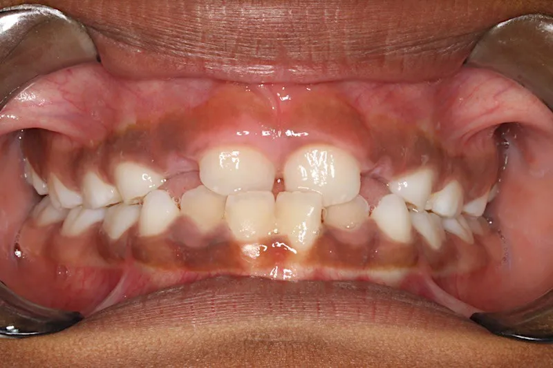 Before photo: Expander Case Study #3 in Somerville NJ