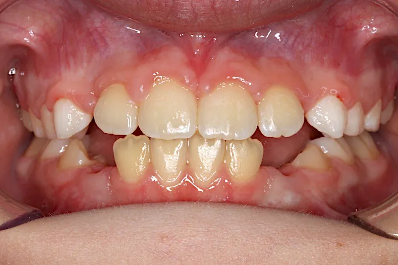 After photo: Expander and Braces Case Study #4 in Somerville NJ