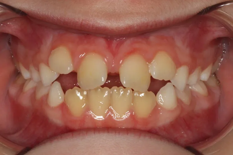 Before photo: Expander and Braces Case Study #4 in Somerville NJ