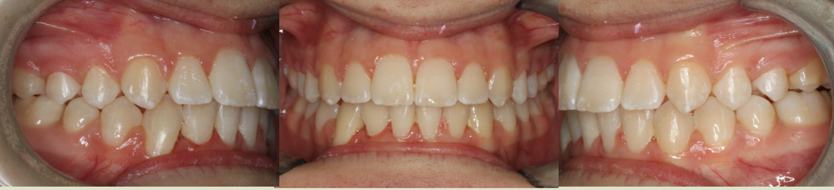 After photo (front view of teeth): Severe Dental Crowding - Palate Expander & Braces, Case Study #6
