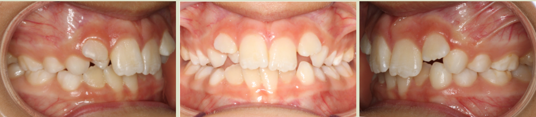Before photo (front view of teeth): Severe Dental Crowding - Palate Expander & Braces, Case Study #6